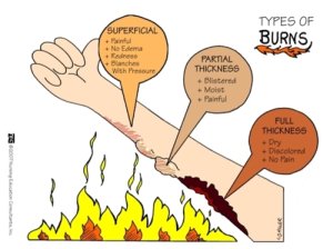 Types of Burns